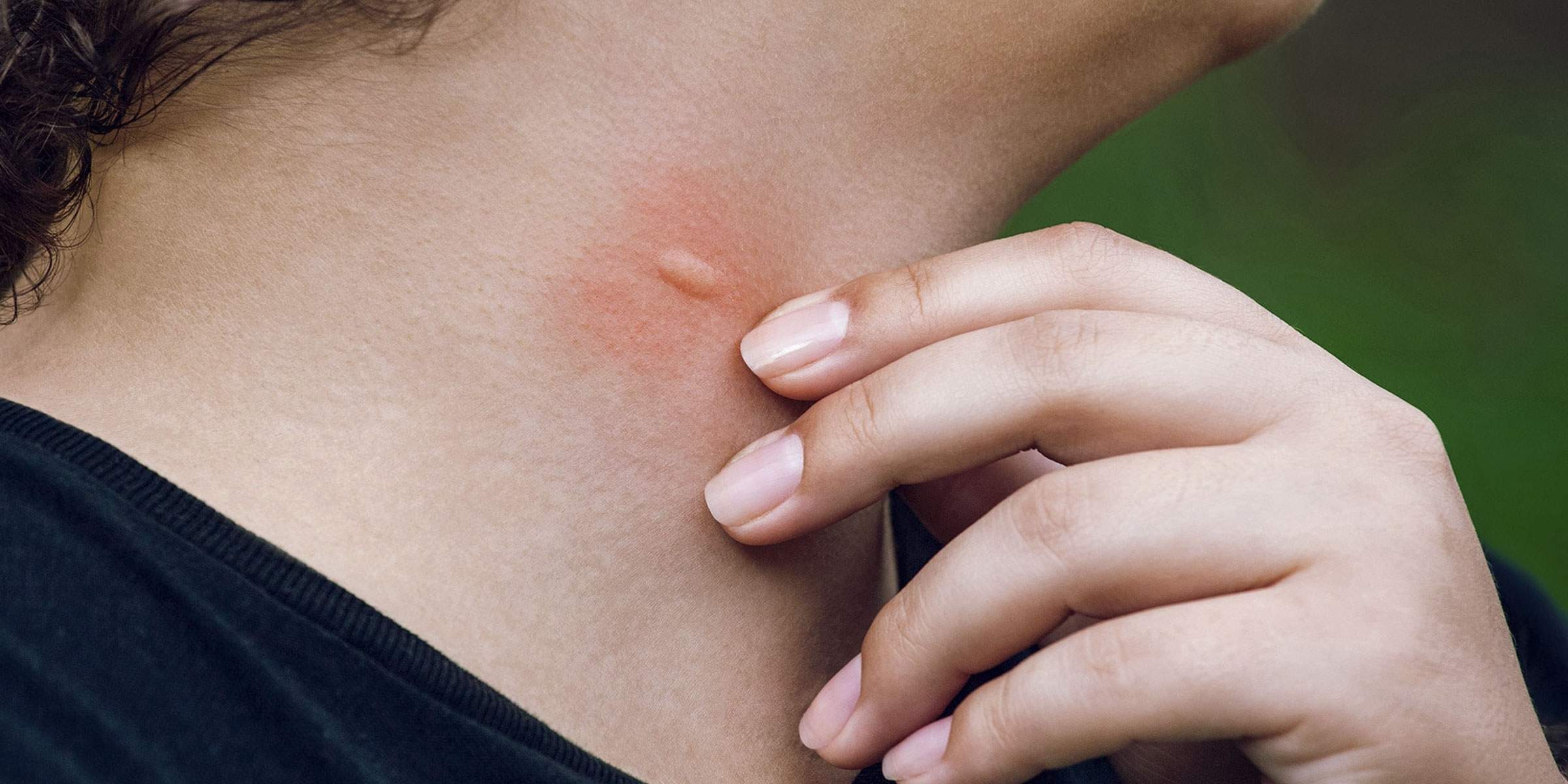 Mosquitoes can cause itchy and red bumps Relieve itching after an insect bite